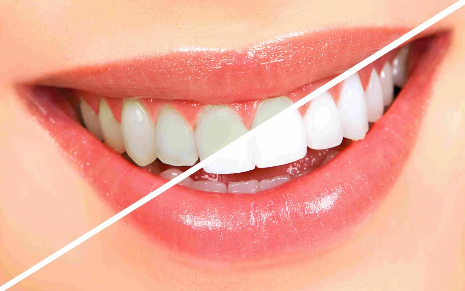 Sourire avant/après un blanchiment dentaire : dents jaunies à gauche, dents blanchies à droite
