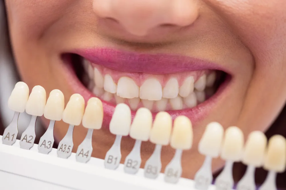 Nuancier de teintes dentaires comparé au sourire naturel pour évaluer le résultat