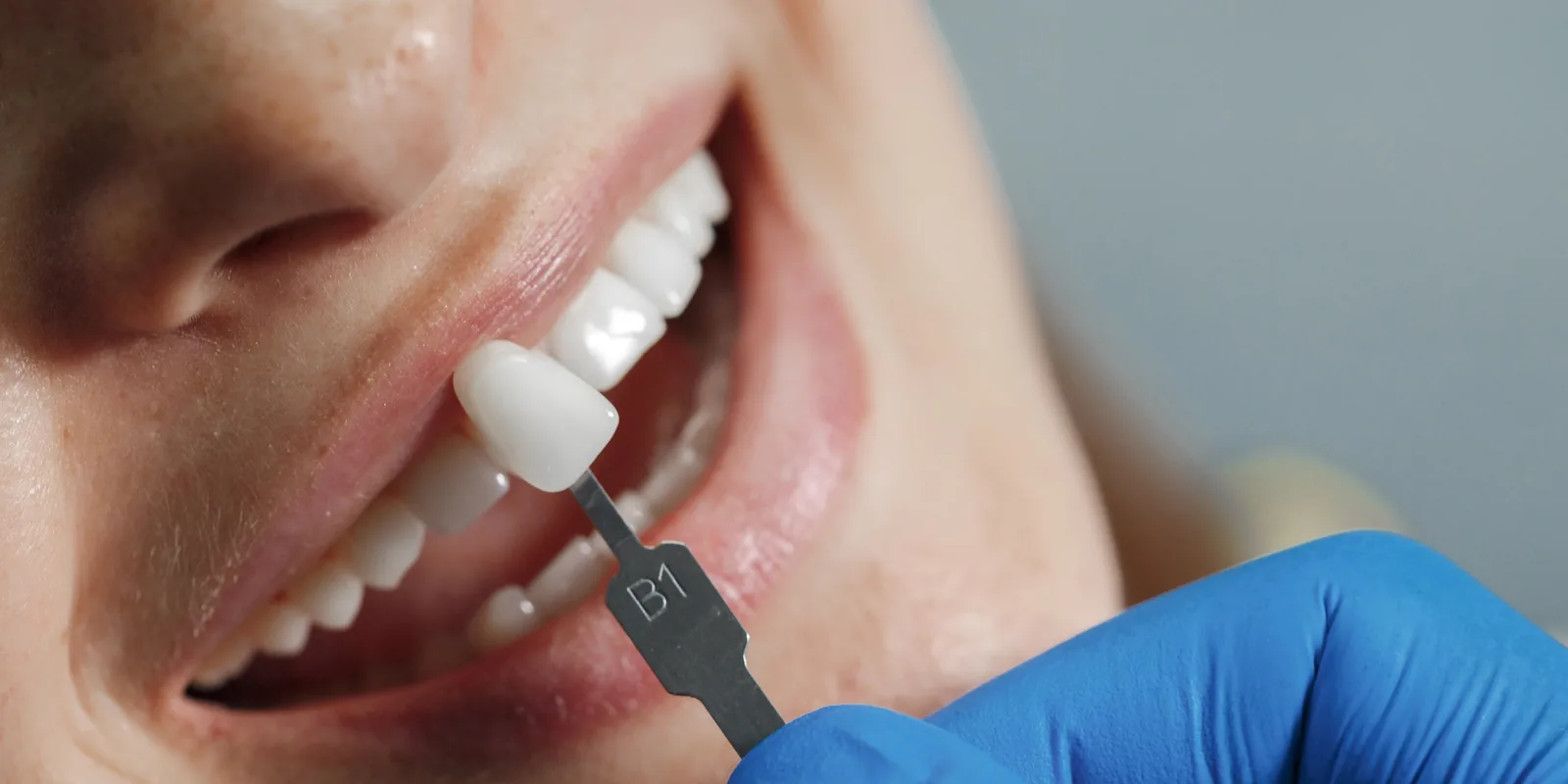 Essayage d'une facette dentaire (teinte B1) sur une dent naturelle