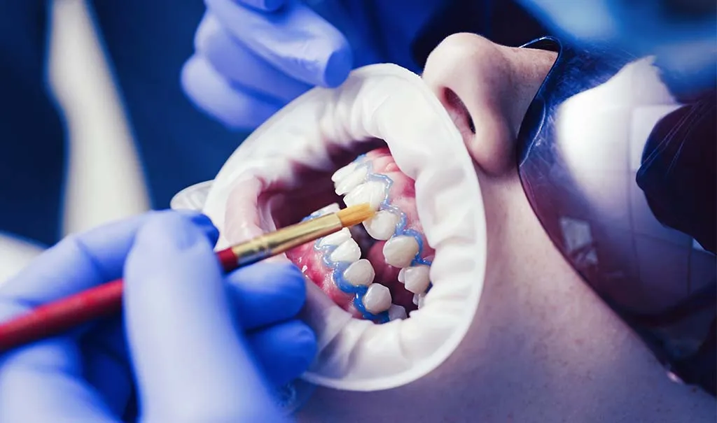 Application du gel de blanchiment professionnel, gencives protégées
