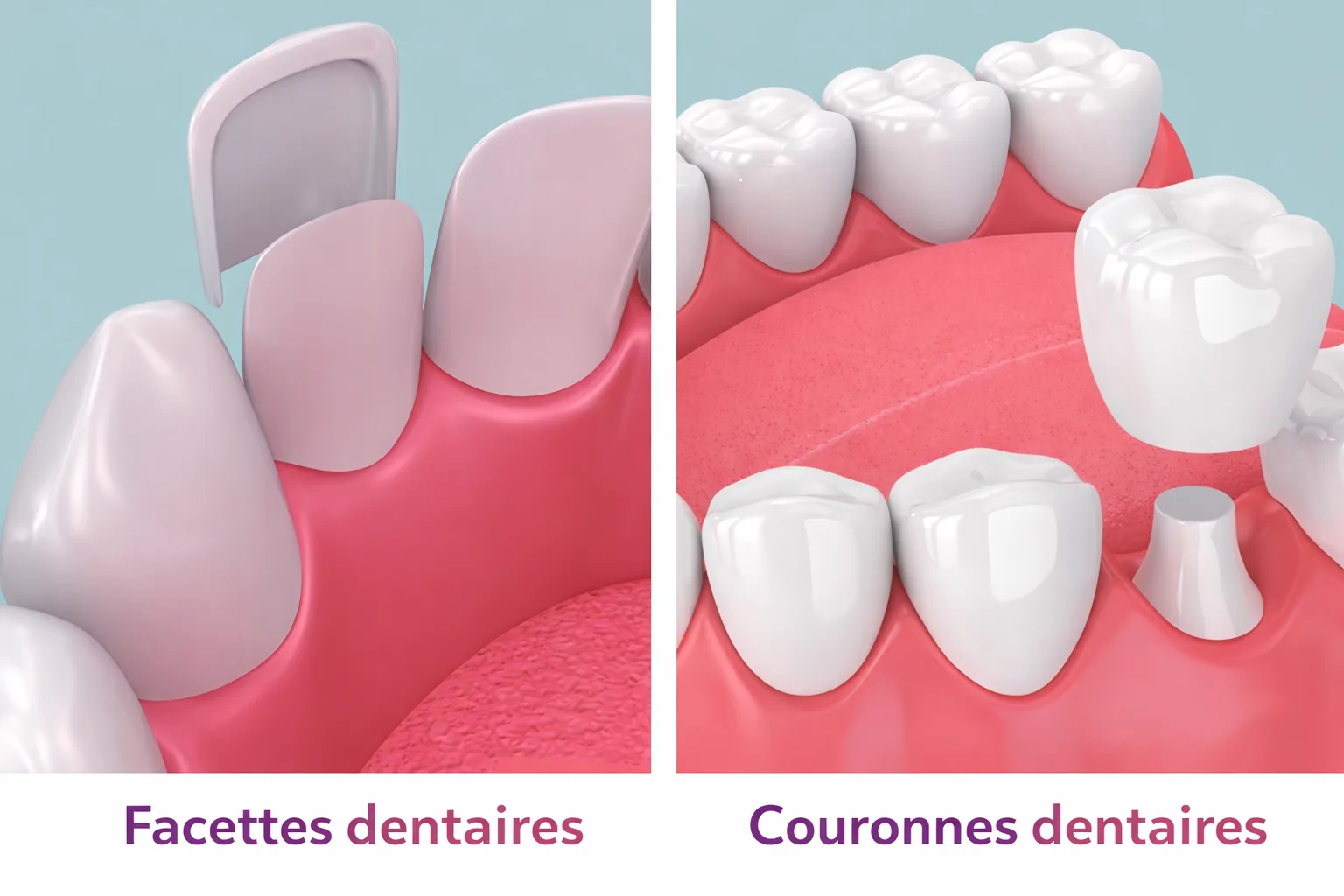 Illustration des couronnes et facettes dentaires au cabinet EL MISRI