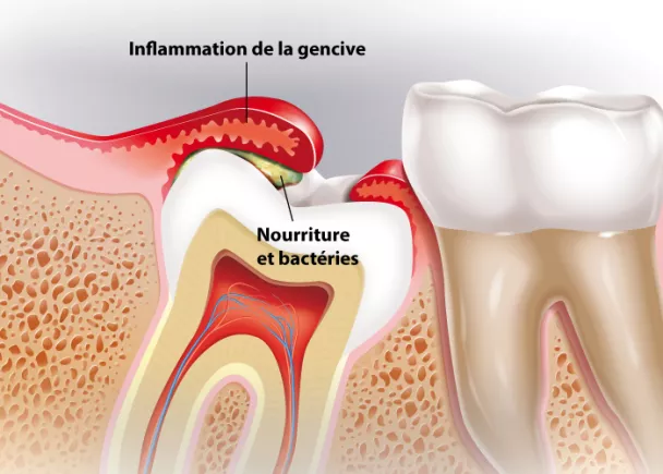 Schéma de l'inflammation de la gencive et de l'accumulation de bactéries autour d'une dent de sagesse partiellement sortie