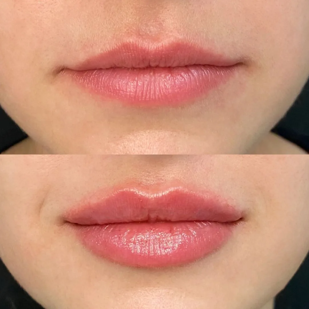 Illustration du soin Fillers à l'acide hyaluronique