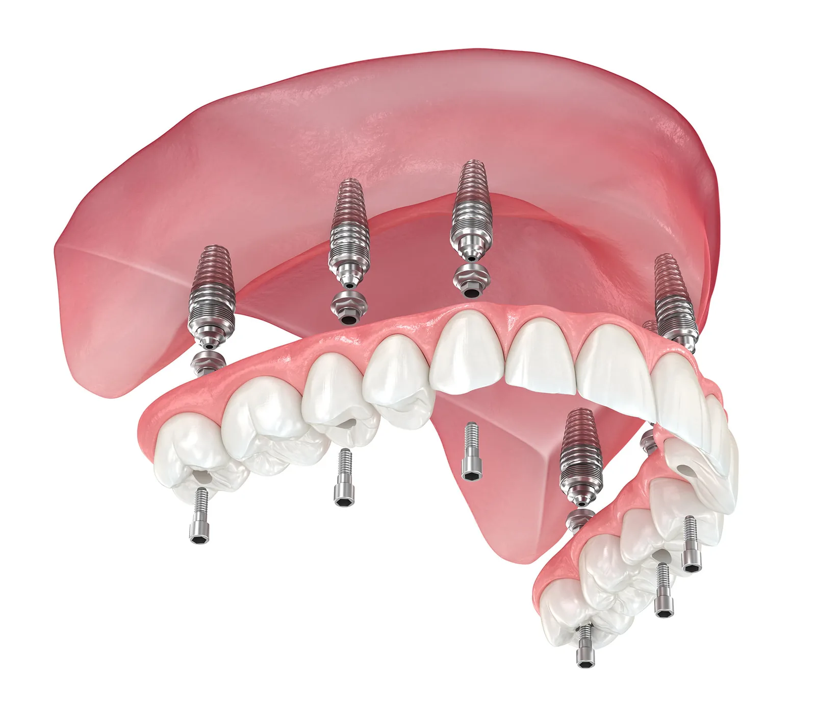 Illustration du principe d'ancrage de plusieurs implants dans l'os