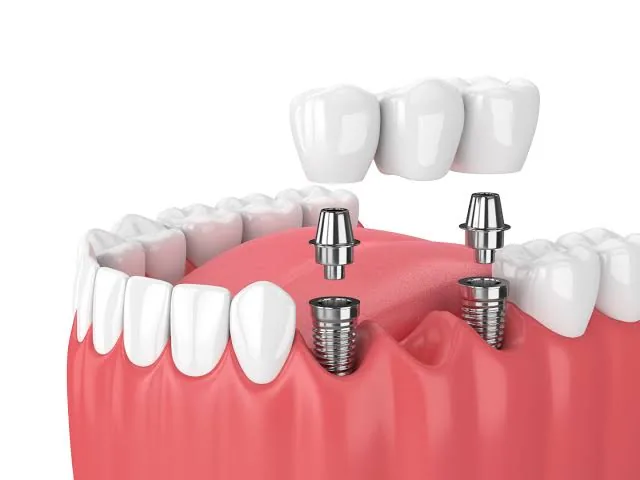 Illustration d'un implant et de la couronne posée dessus