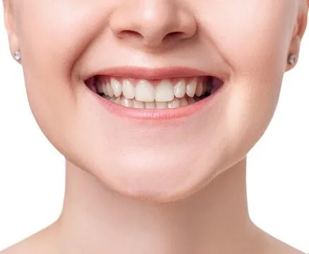 Illustration du résultat après la pose d'un implant dentaire