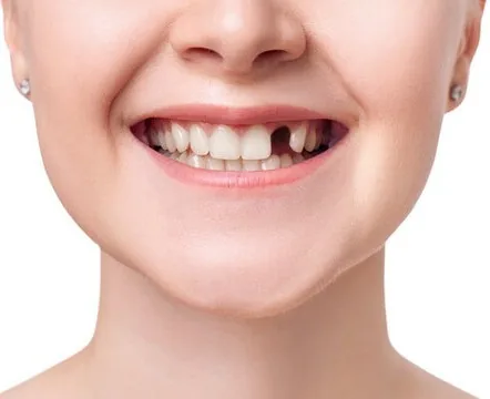 Illustration de l'état initial avant la pose d'un implant dentaire