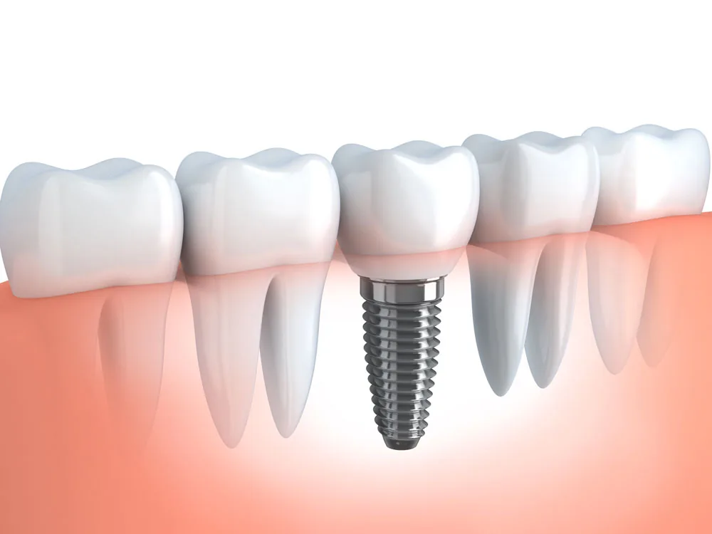 Illustration de l'implant dentaire au cabinet EL MISRI