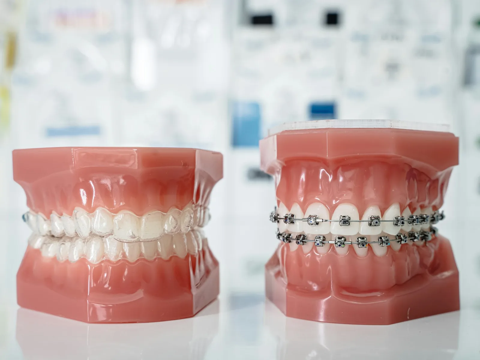 Comparaison entre gouttière transparente et bagues classiques