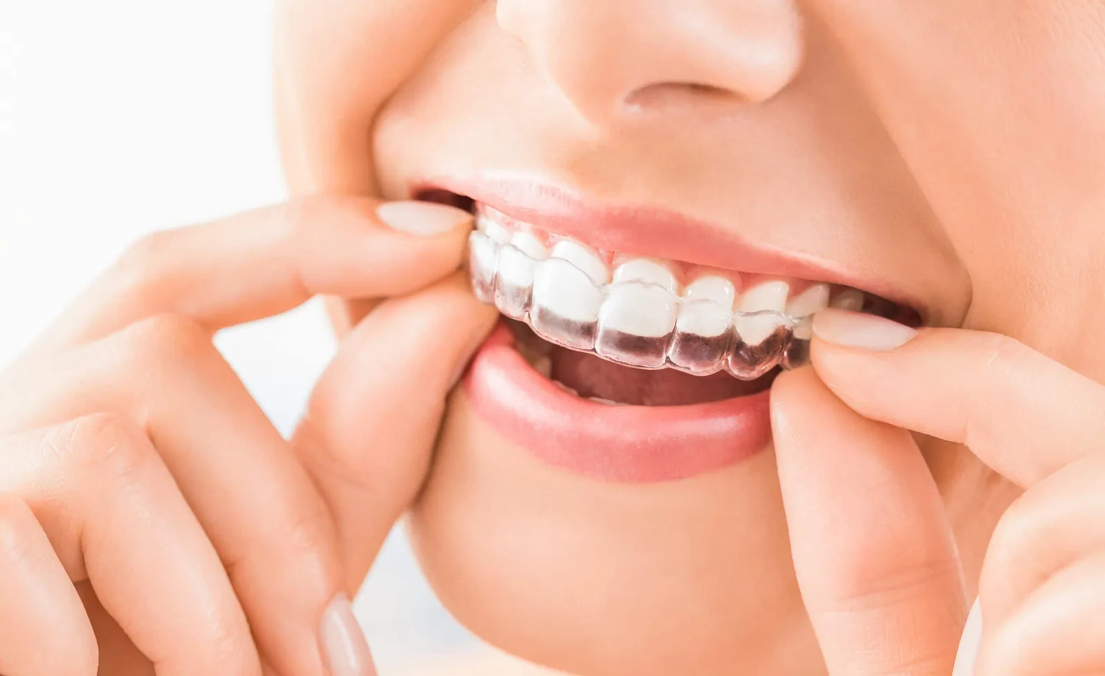 Illustration de l'orthodontie invisible au cabinet EL MISRI