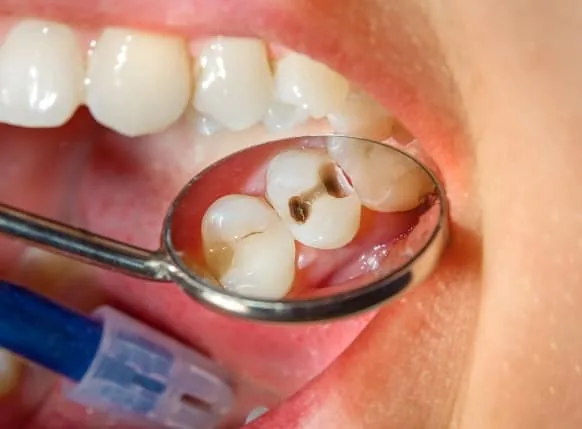 Carie visible au miroir buccal lors d'un contrôle
